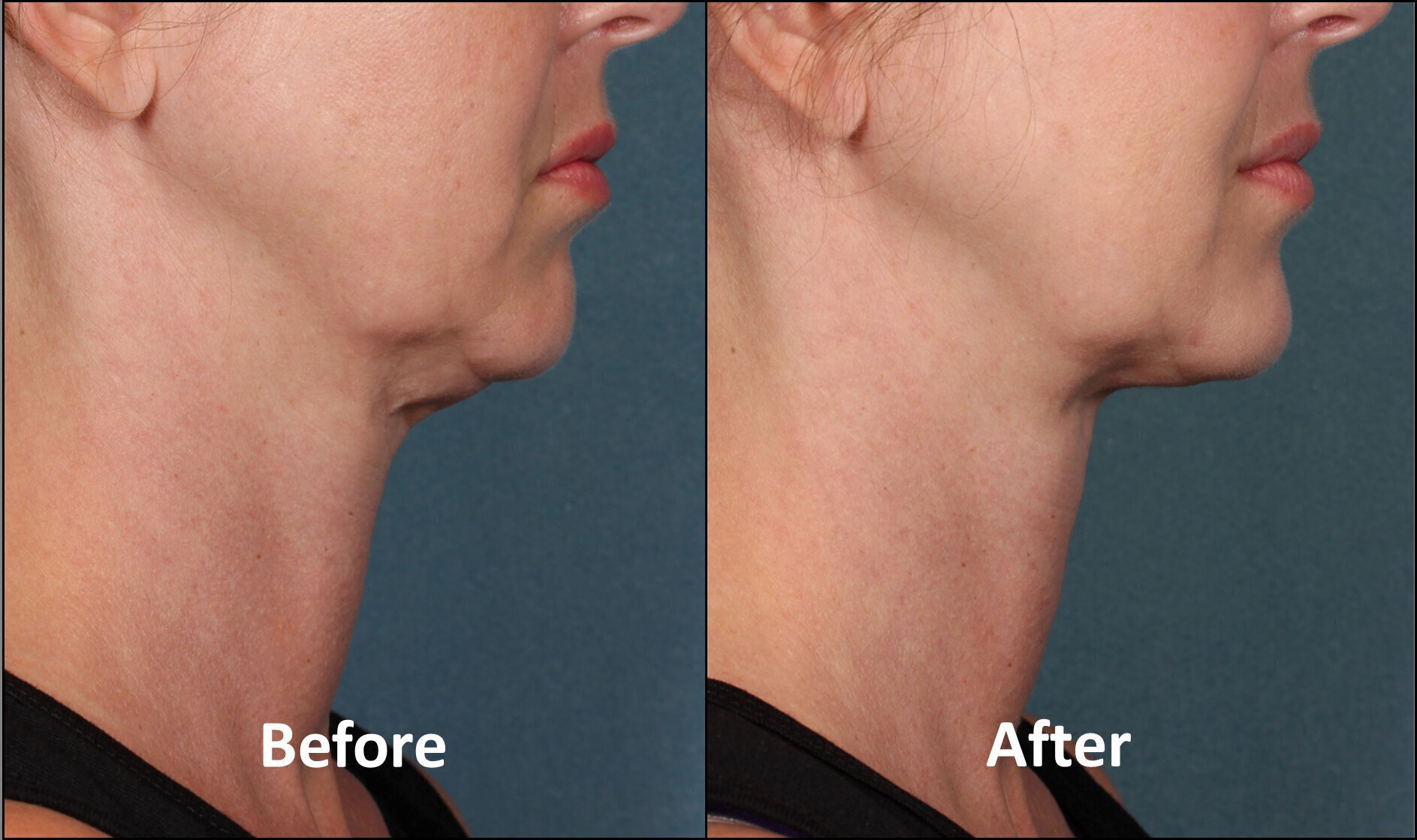 Vero Beach Kybella Before & After
