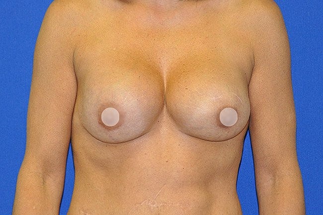 Breast anatomy illustration on blue background.
