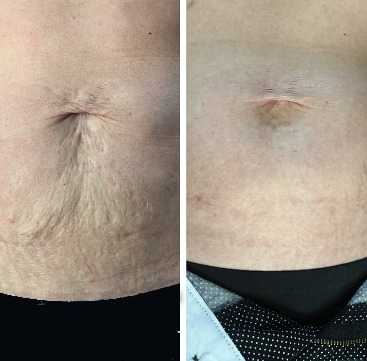 Before and after images of abdominal skin texture.