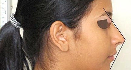 Profile view of a woman with annotations.