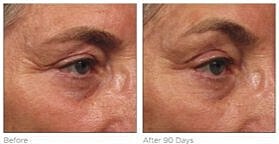 Before and after skincare treatment results.