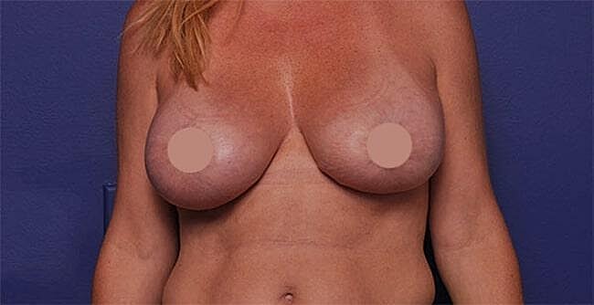 Breast Lift With Augmentation Before & After