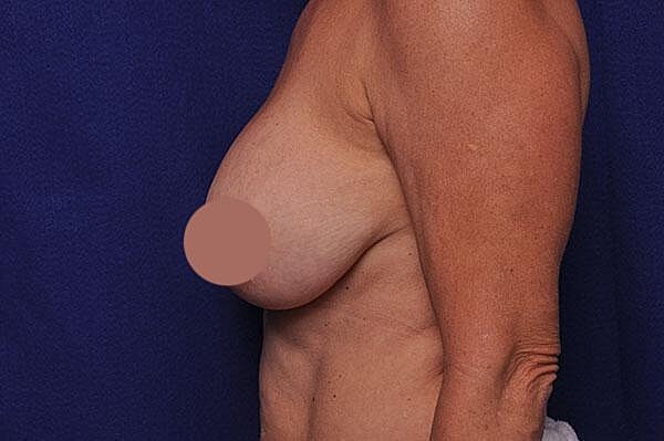 Breast Lift With Augmentation Before & After