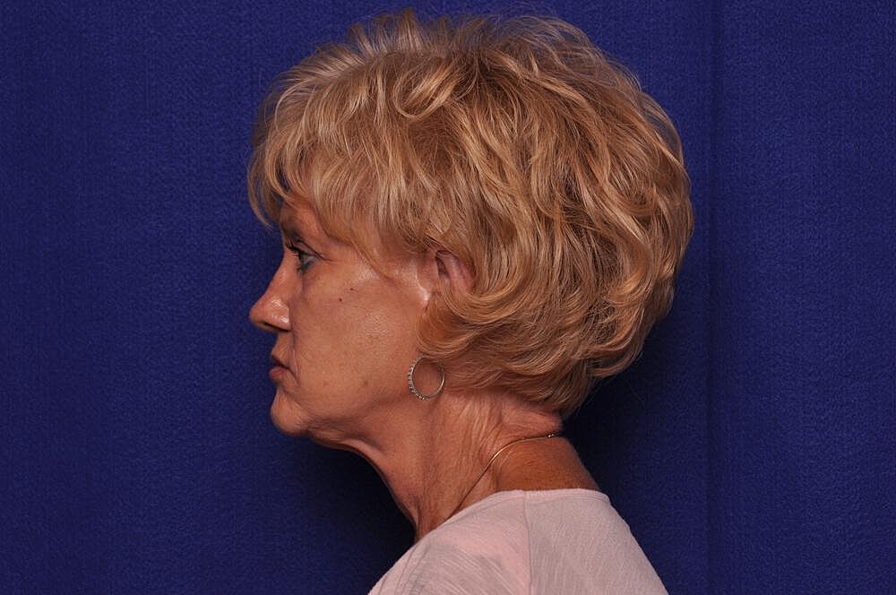 Renuva Before & After