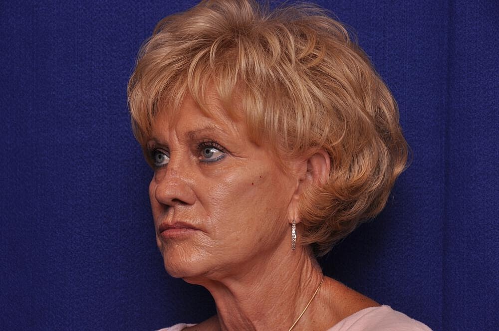 Renuva Before & After