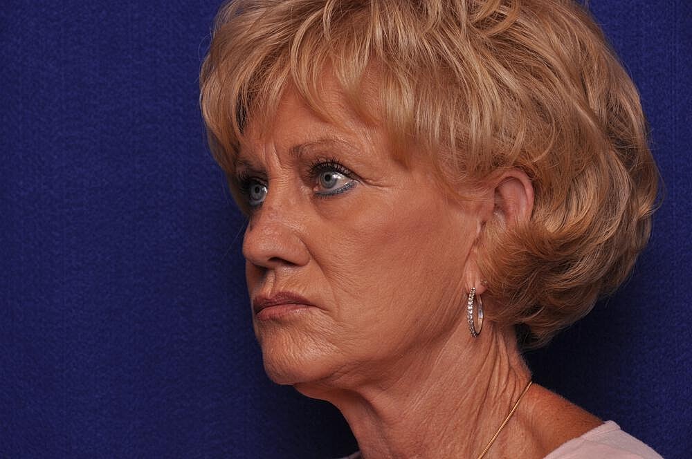 Renuva Before & After