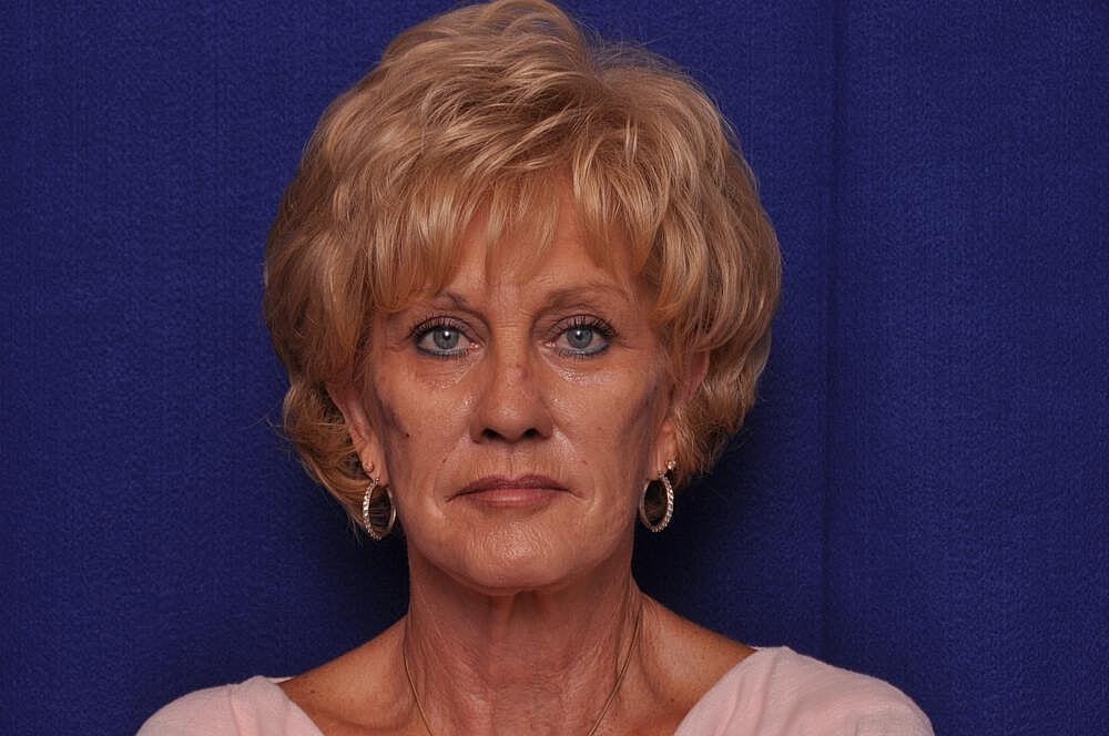 Renuva Before & After