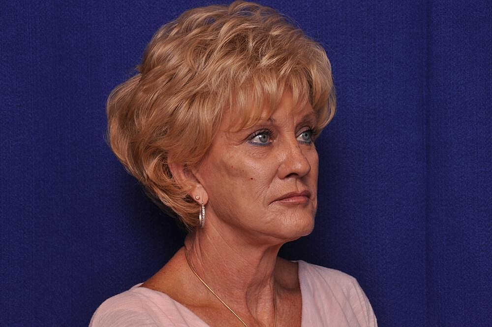 Renuva Before & After