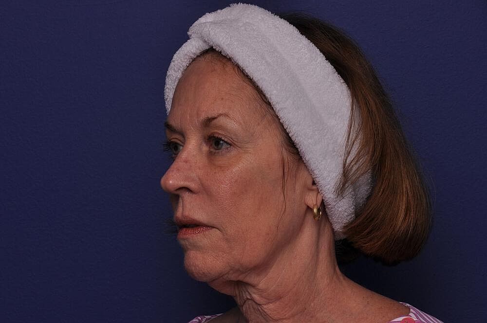 Renuva Before & After