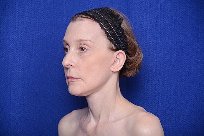 Brow Lift Before & After