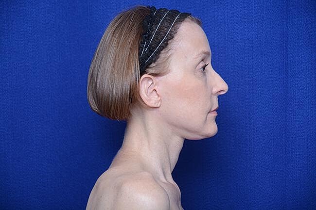 Brow Lift Before & After