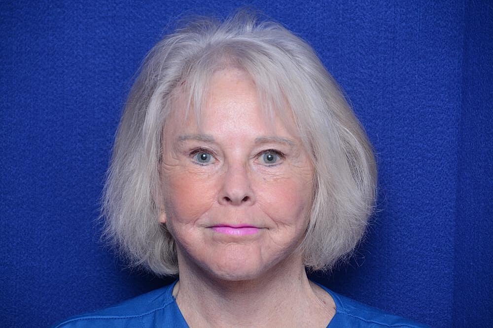 Brow Lift Before & After