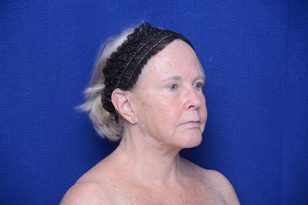 Brow Lift Before & After