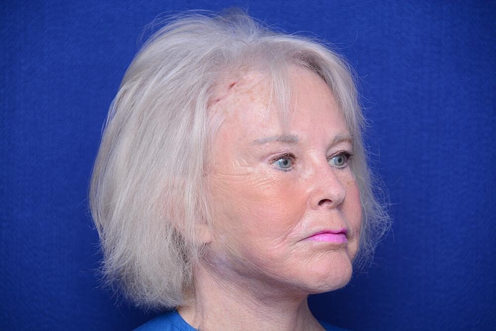 Brow Lift Before & After