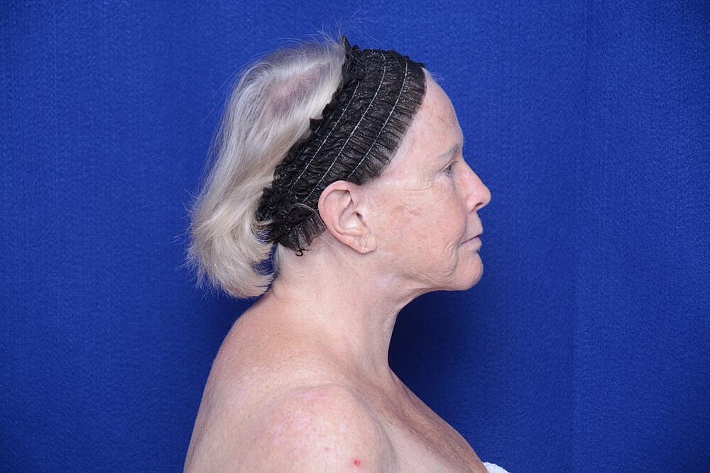 Brow Lift Before & After