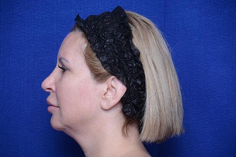 Chin Implant Before & After