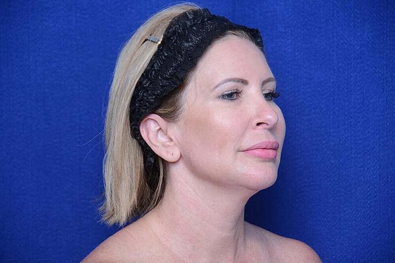 Chin Implant Before & After