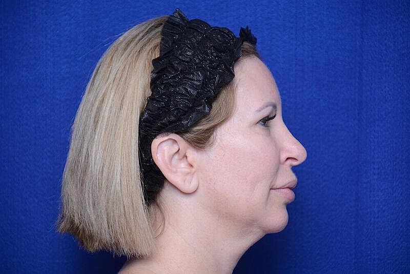 Chin Implant Before & After