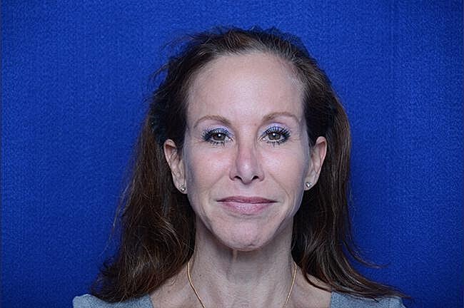 Xeomin Before & After