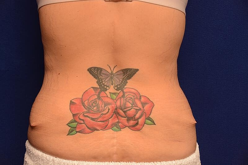 Body Lift Before & After