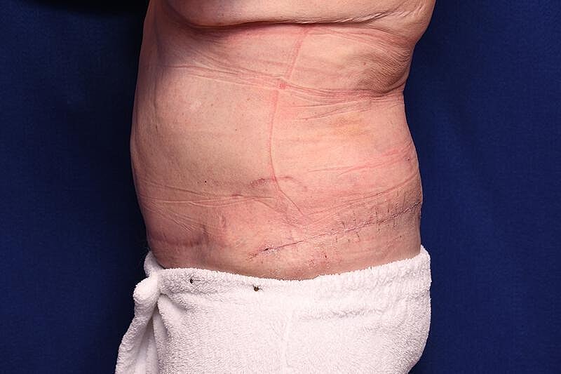 Body Lift Before & After