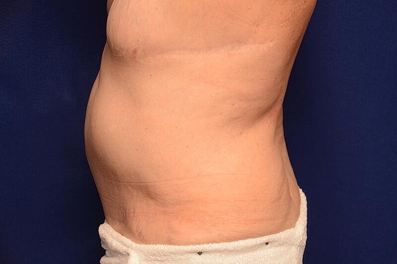 Body Lift Before & After