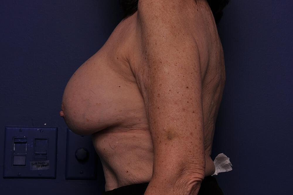 Breast Revision Before & After