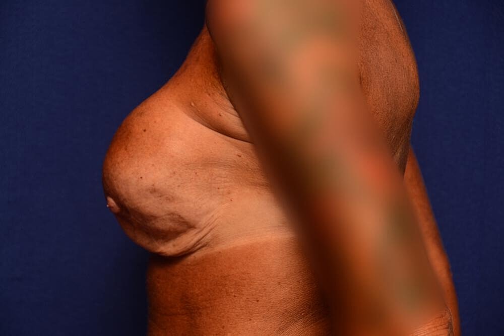 Breast Revision Before & After