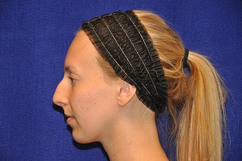Rhinoplasty Before & After