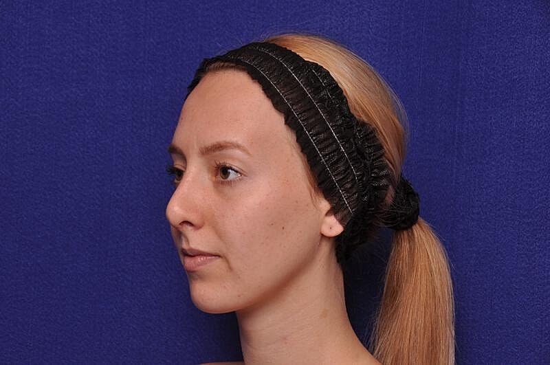 Rhinoplasty Before & After