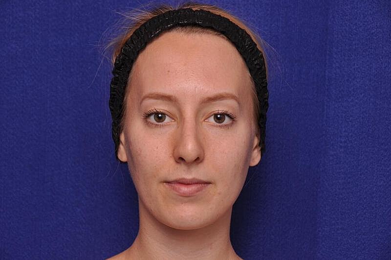 Rhinoplasty Before & After