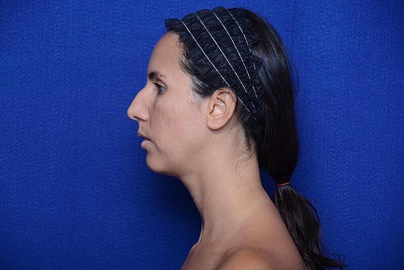 Rhinoplasty Before & After