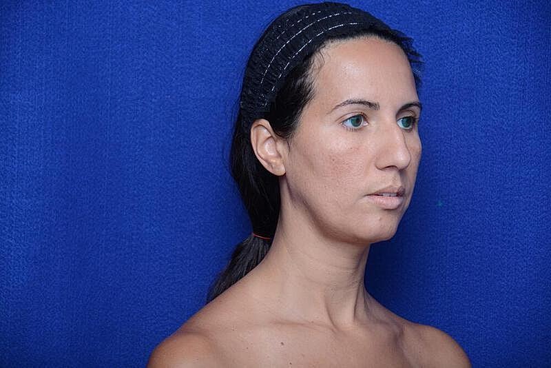 Rhinoplasty Before & After