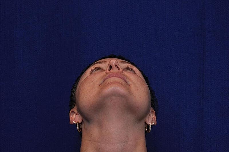 Rhinoplasty Before & After