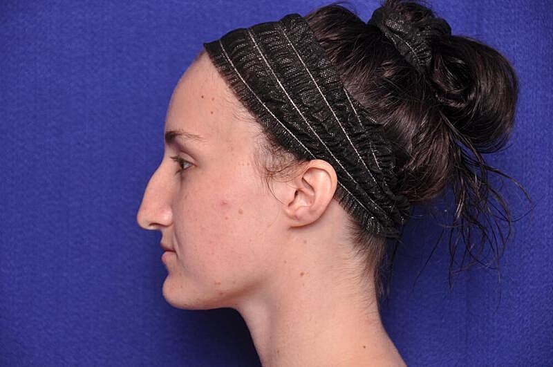 Rhinoplasty Before & After