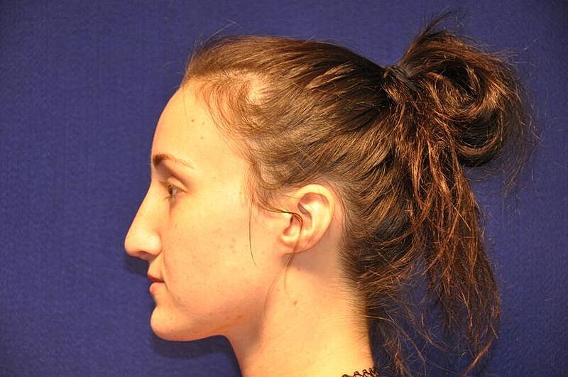 Rhinoplasty Before & After