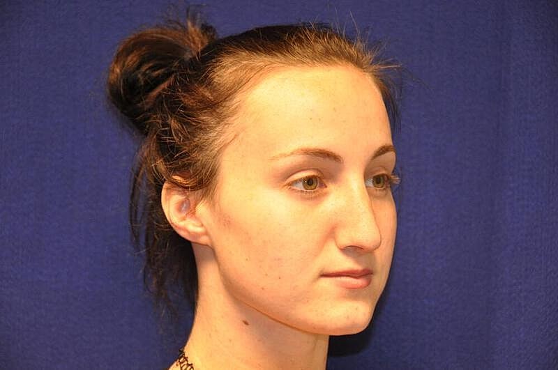 Rhinoplasty Before & After