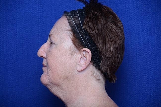 Rhinoplasty Before & After