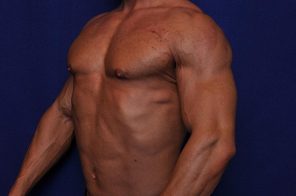 Athletic Gynecomastia Surgery Before & After