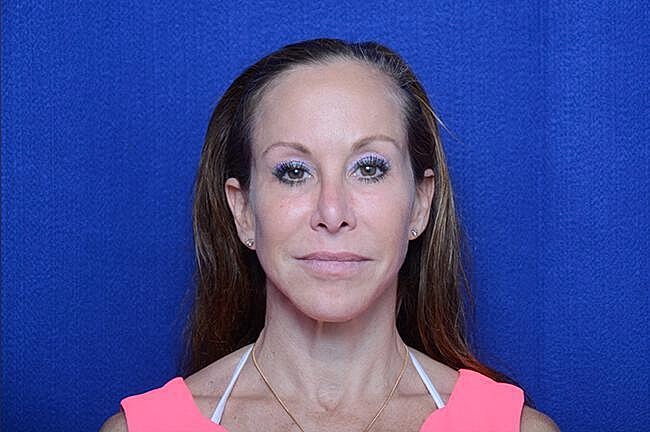 Chemical Brow Lift Before & After