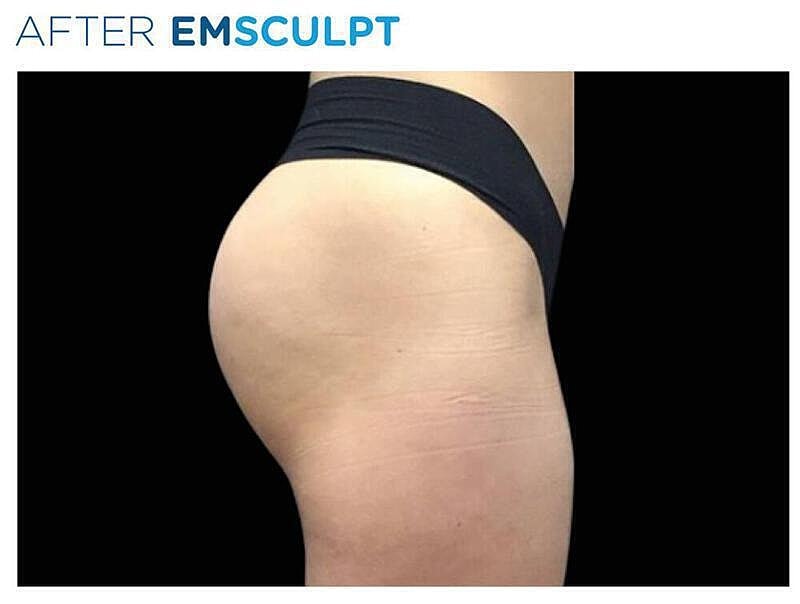Emsculpt Gluteal Before & After