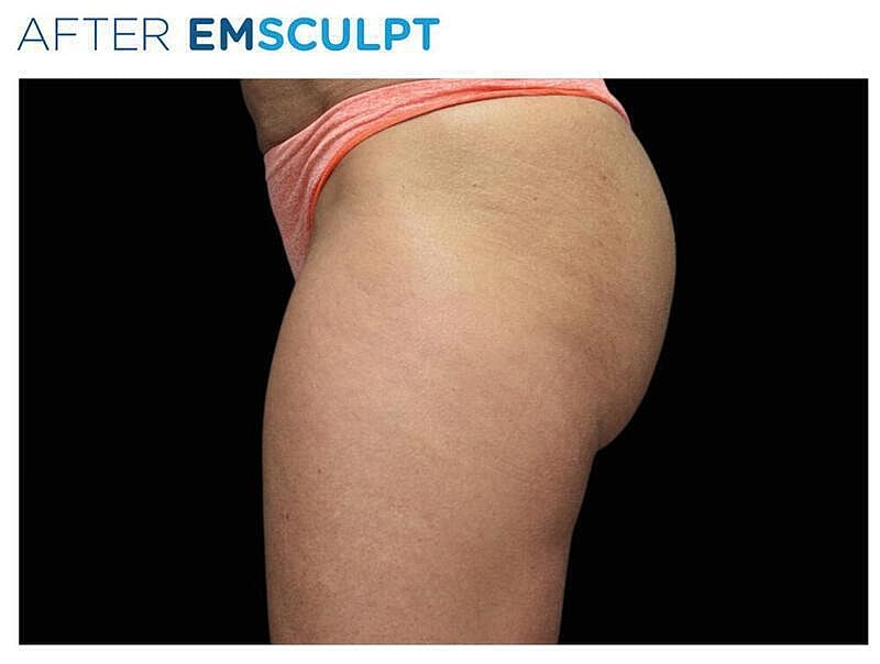 Emsculpt Gluteal Before & After