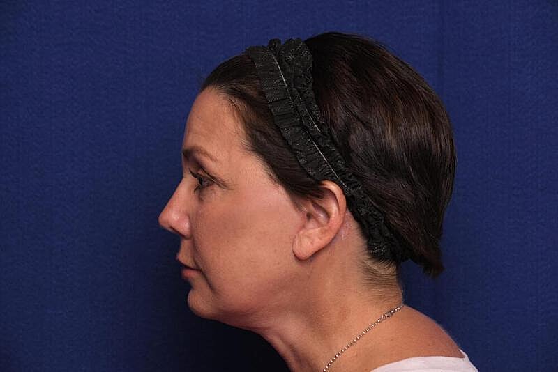 Facelift Before & After