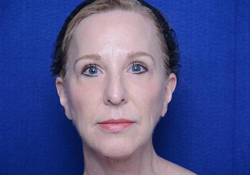 Facelift Before & After