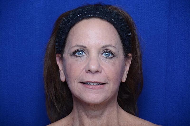 Facelift Before & After