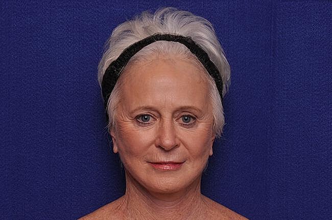 Facelift Before & After