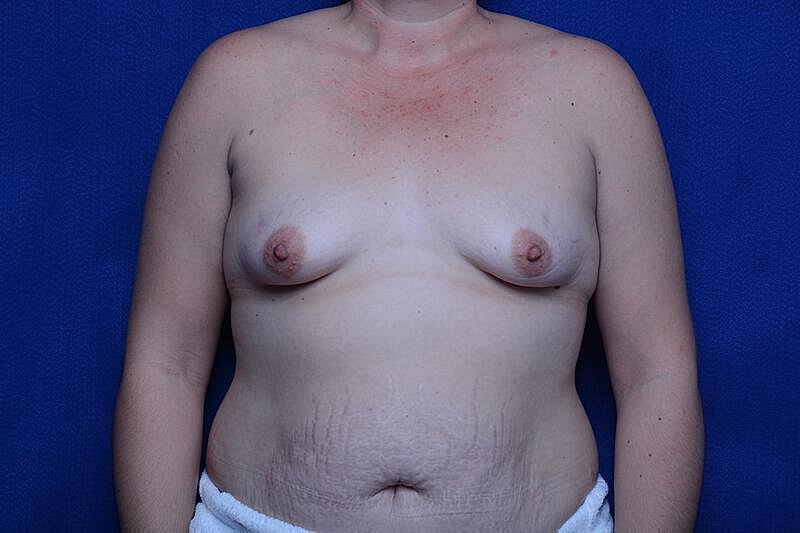 Tuberous Breast Before & After