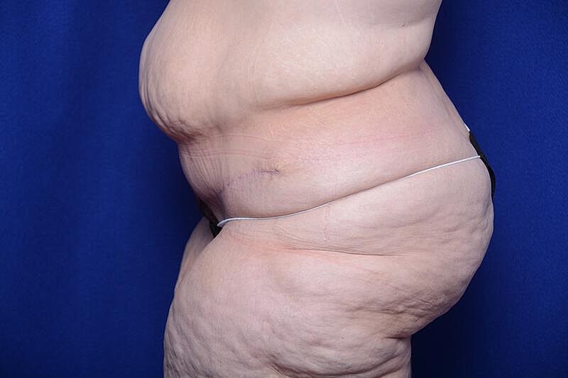 After Massive Weight Loss Surgery Before & After