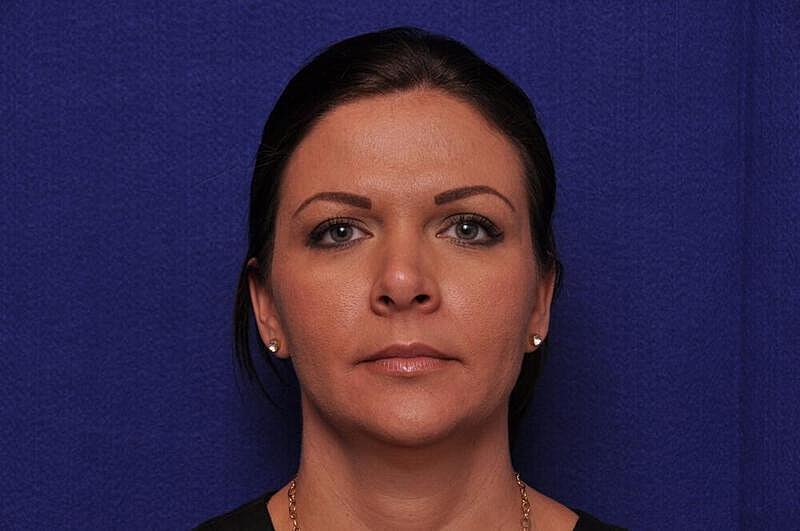 Fractional Laser Before & After