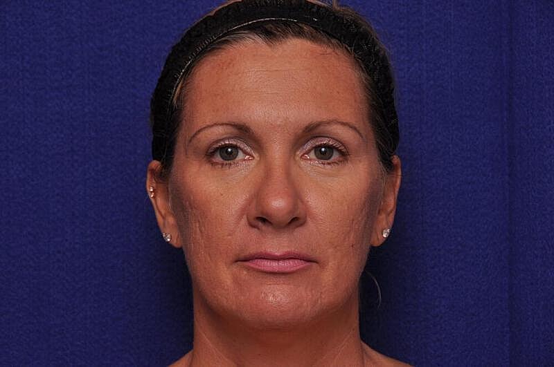 Fractional Laser Before & After